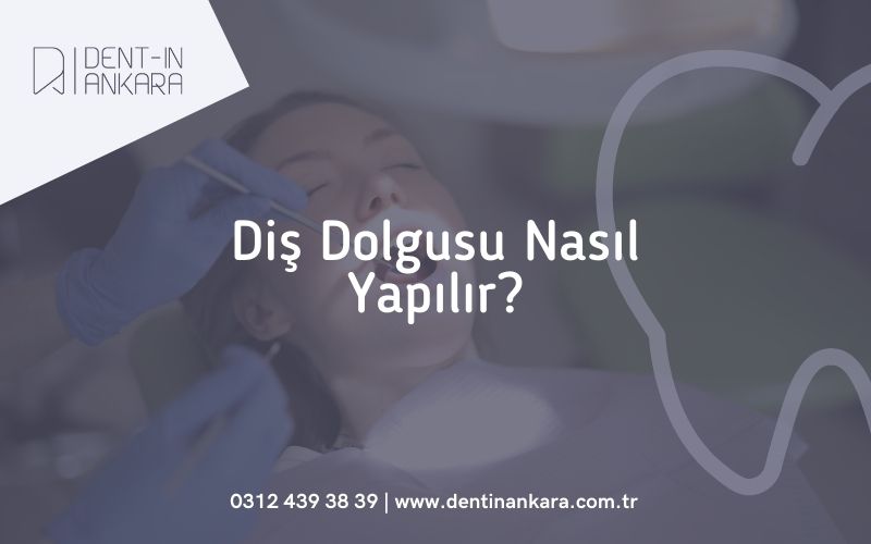 Diş Dolgusu Nasıl Yapılır