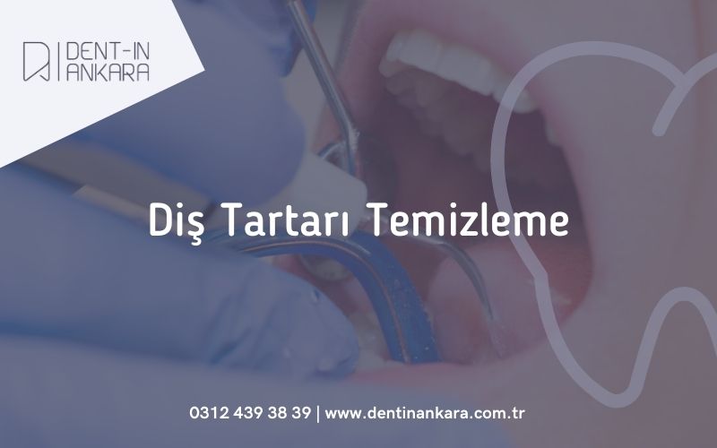 Diş Tartarı Temizleme