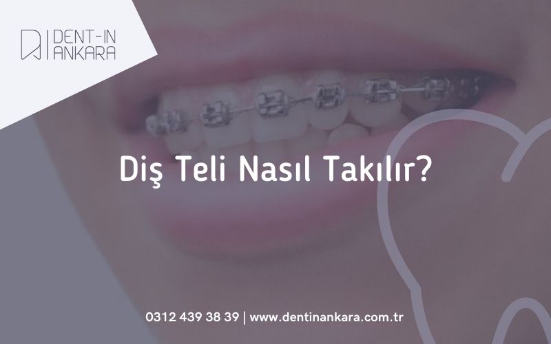 Diş Teli Nasıl Takılır