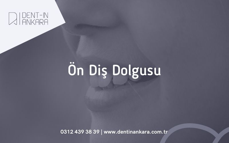 Ön Diş Dolgusu