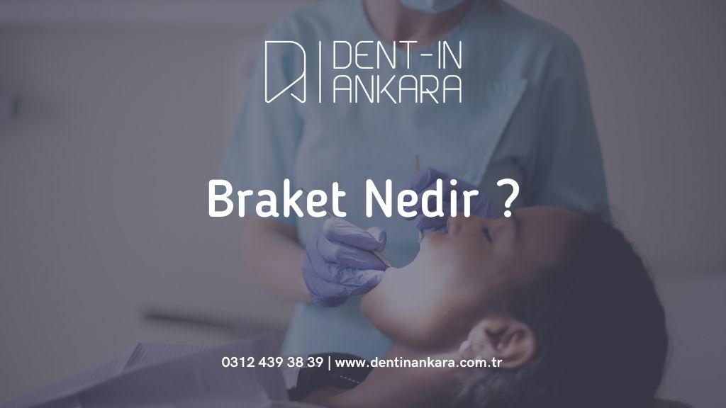 Braket Nedir